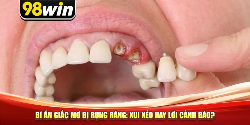 Bí Ẩn Giấc Mơ Bị Rụng Răng - Xui Xẻo Hay Lời Cảnh Báo?